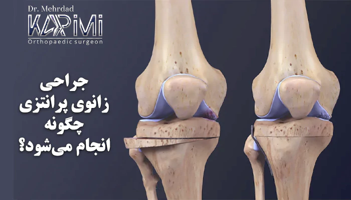 جراحی زانوی پرانتزی چگونه انجام میشود؟