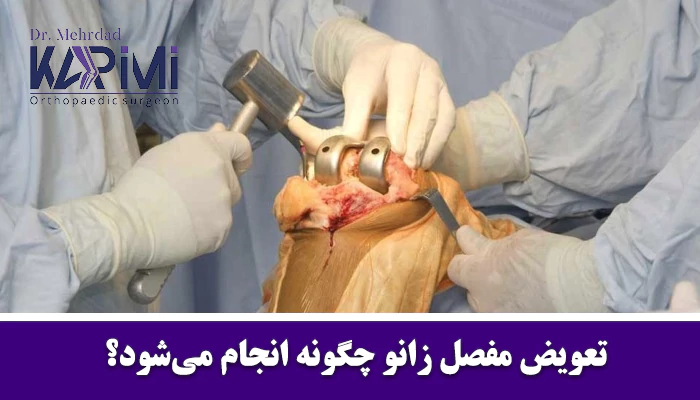 عمل تعویض مفصل زانو چگونه انجام میشود؟