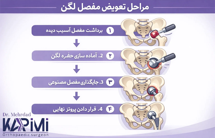 مراحل تعویض مفصل لگن به چه صورت است؟