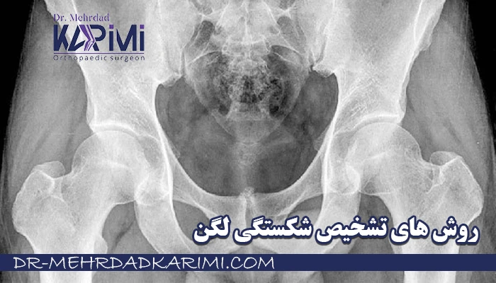 روش های تشخیص شکستگی لگن