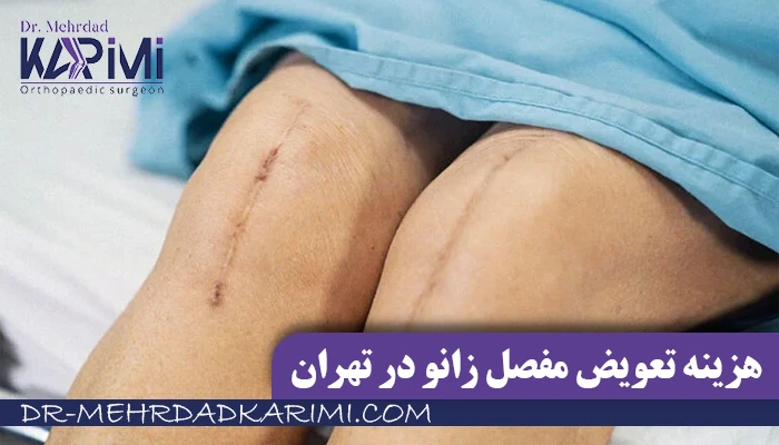 هزینه تعویض مفصل زانو - دکتر مهرداد کریمی