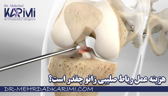 هزینه عمل رباط صلیبی زانو چقدر است؟