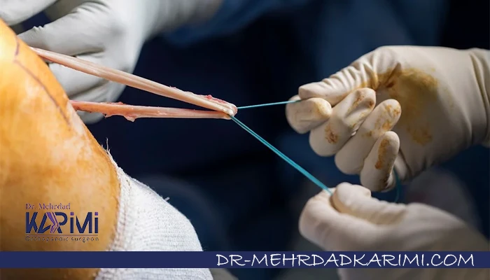 چگونه یک جراح ACL باتجربه را از سایر پزشکان تشخیص دهیم؟