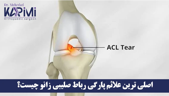 اصلی ترین علائم پارگی رباط صلیبی زانو چیست؟