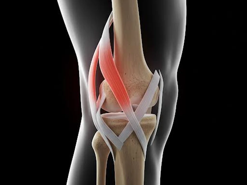علائم پارگی رباط صلیبی زانو چیست؟ - دکتر مهرداد کریمی