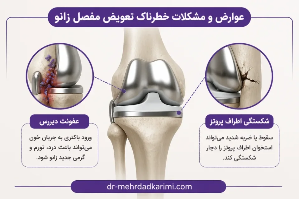 عفونت دیررس و شکستگی اطراف پروتز — نمای مفهومی خطرات بلندمدت شامل شلشدن پروتز و شکستگی اطراف مفصل مصنوعی زانو